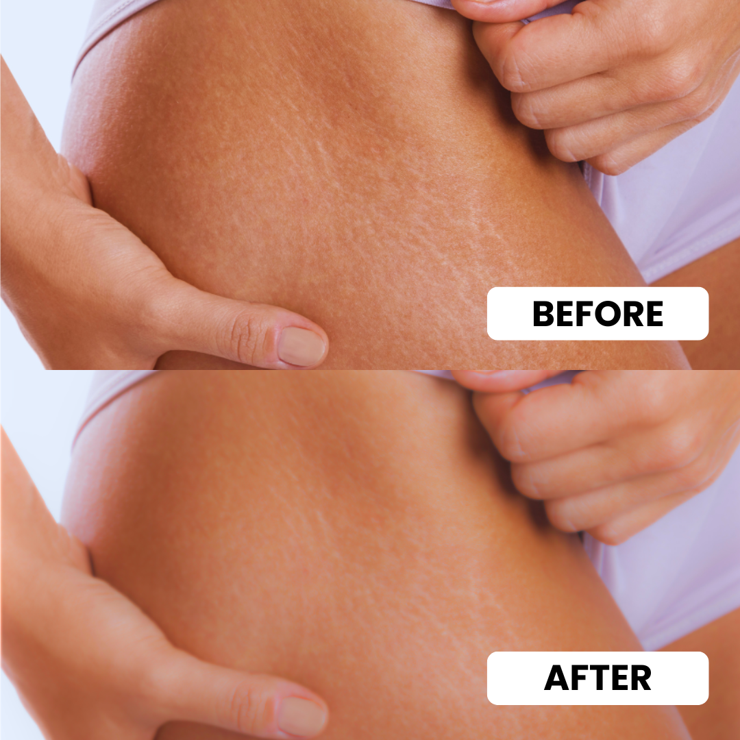 Stretch Mark Eraser